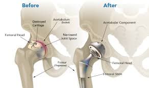 Joint Replacement - Orthopedic Service