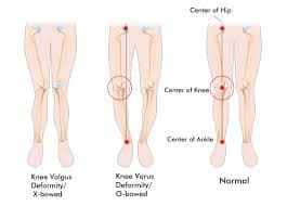 ACL Reconstruction by Dr. Anshul Goel in Delhi
